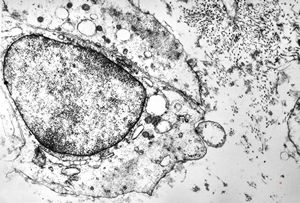 F, 62y. | myxoma atrii